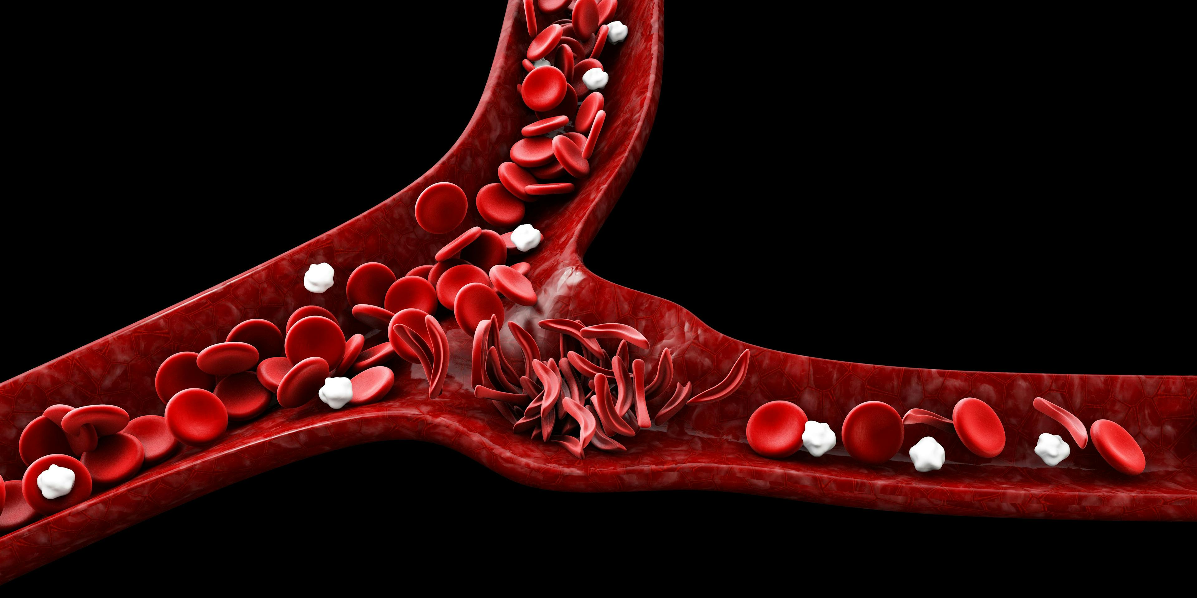 Sickle cell anemia, 3D illustration showing blood vessel with normal and deformed crescent | Image credit: tussik - stock.adobe.com