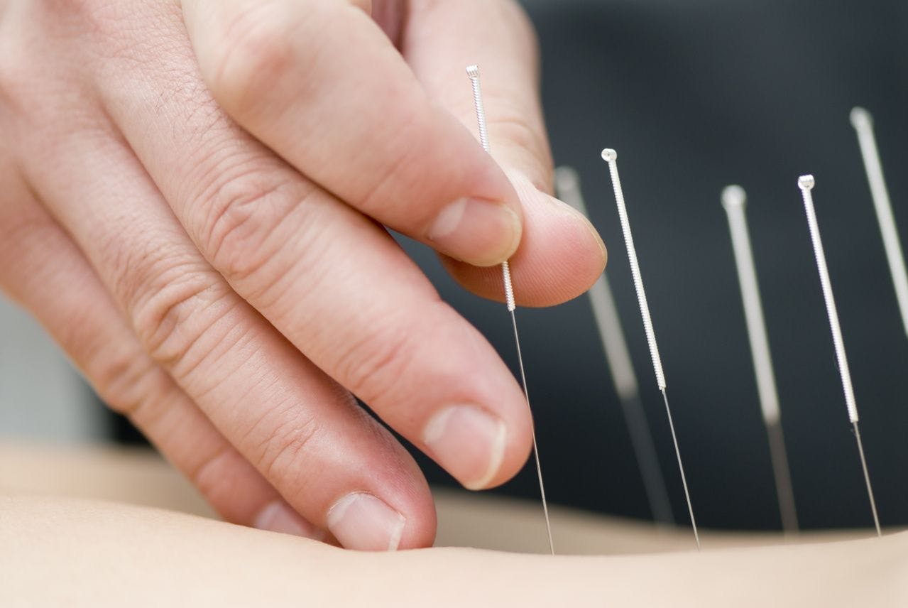Acupuncture for Migraine May Have Some Benefits but Quality of Studies Lacking, Report Says