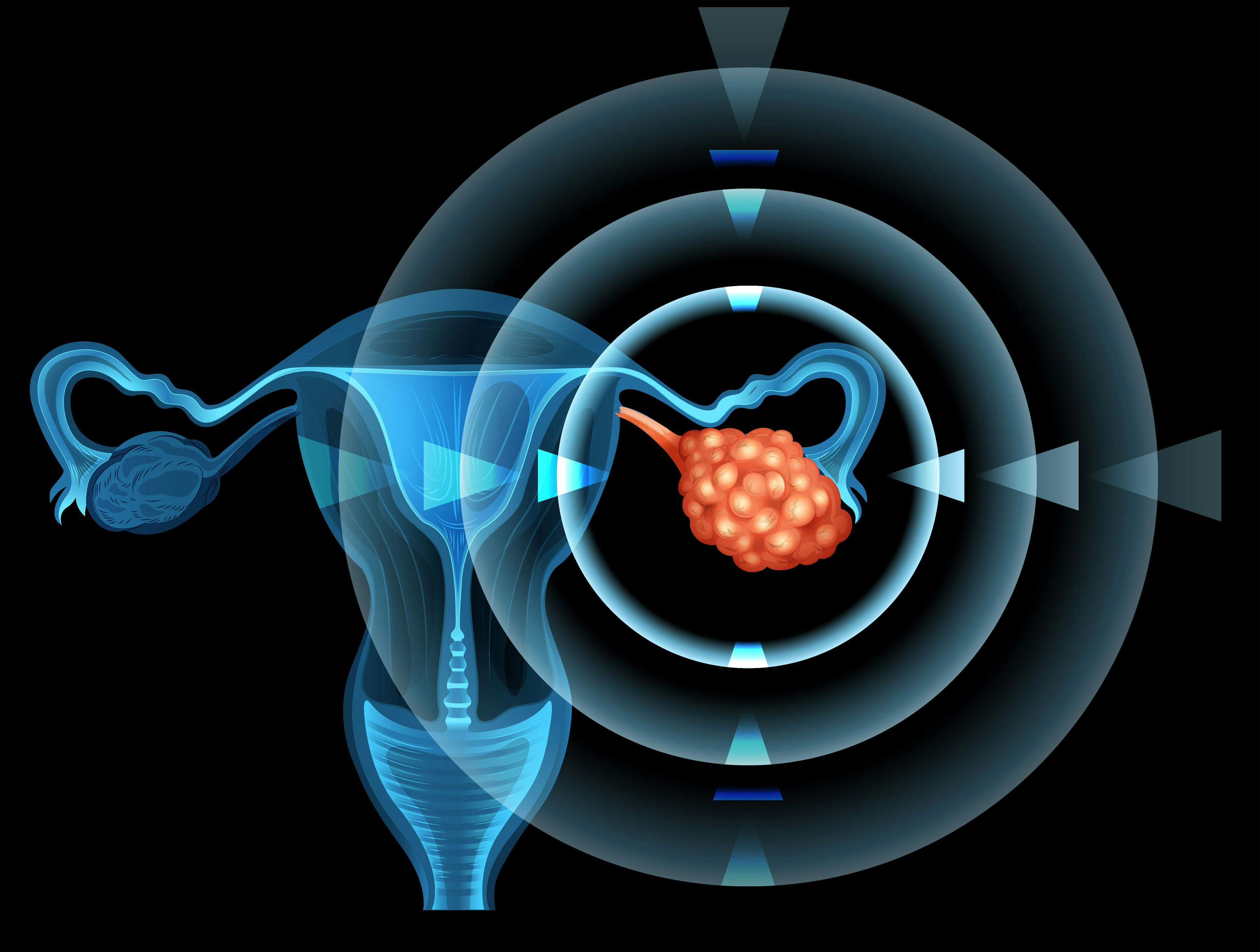 ovarian cancer | Image credit: blueringmedia – stock.adobe.com