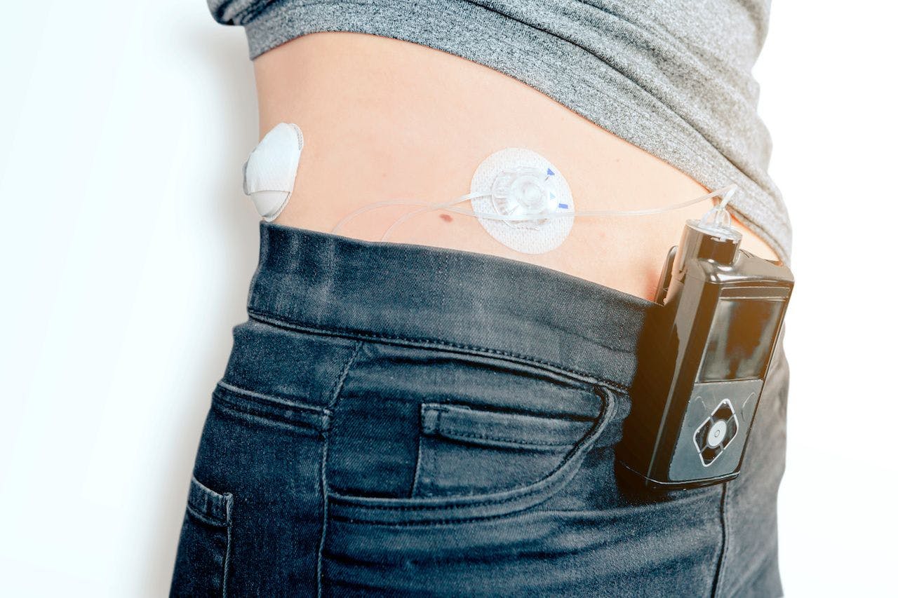 Person with insulin pump connected to stomach | Image credit: Carlo - stock.adobe.com