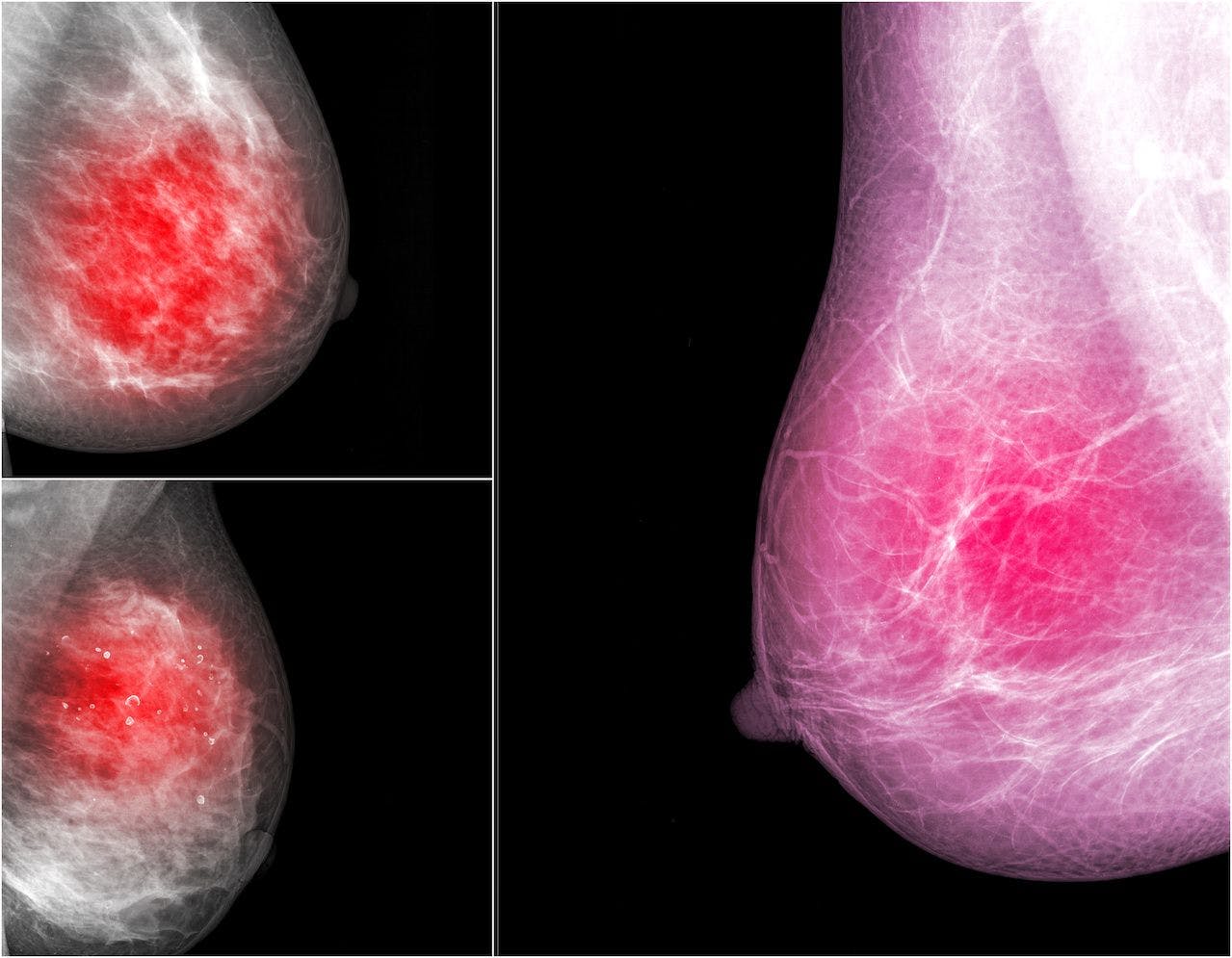Mammography Screening Improves Outcomes Among African American and White American Patients With TNBC