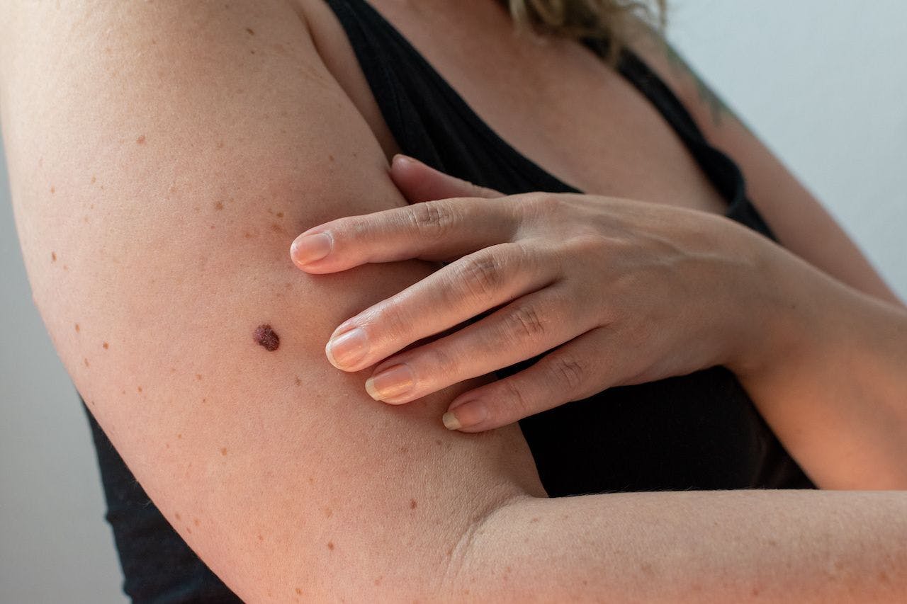 woman checking her skin for an abnormal mole for signs of melanoma skin cancer: © MW Photography - stock.adobe.com