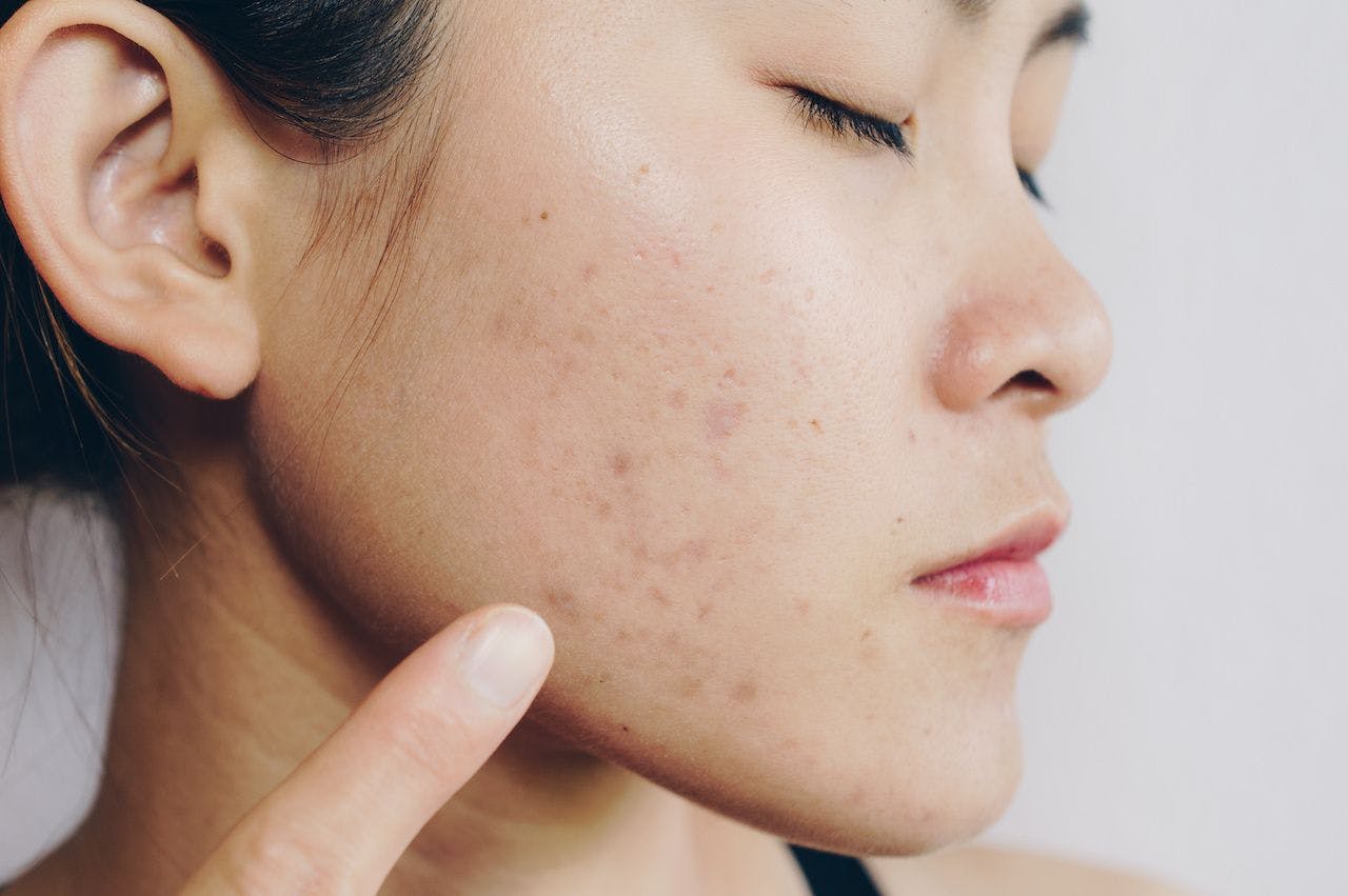 Asian woman has acne problems on her face: © boyloso - stock.adobe.com