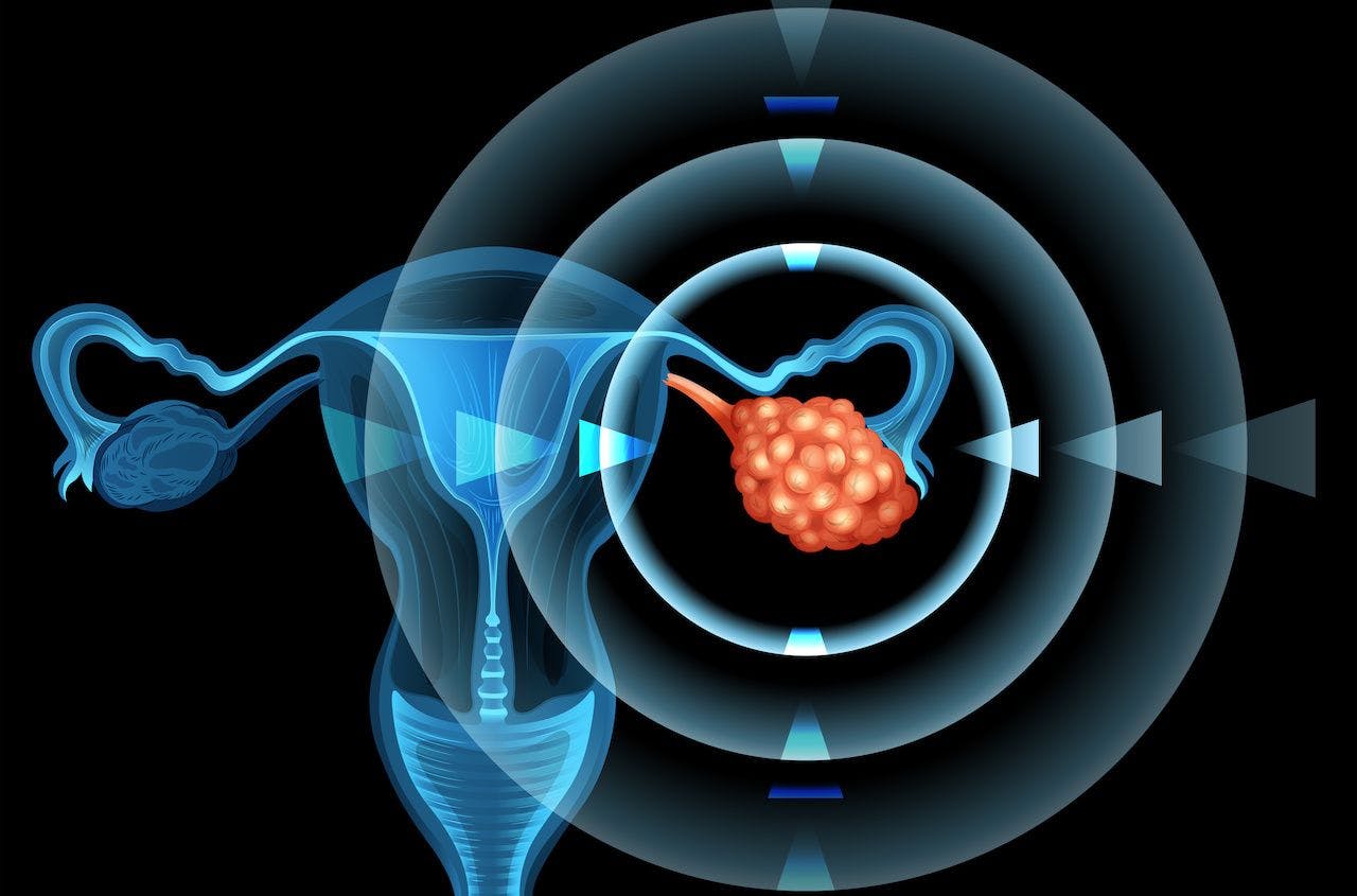 tumor on the ovarian | Image credit: blueringmedia - stock.adobe.com