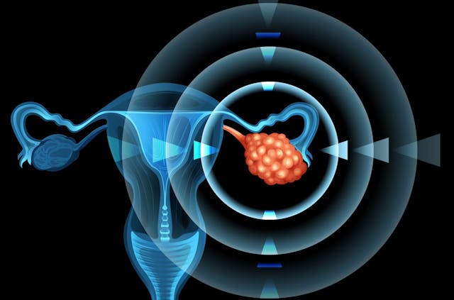 Ovarian cancer | Image credit: blueringmedia - stock.adobe.com