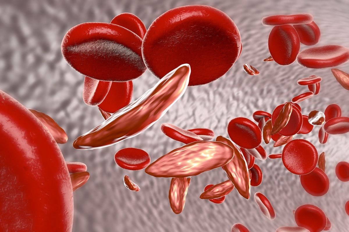 sickle cell graphic