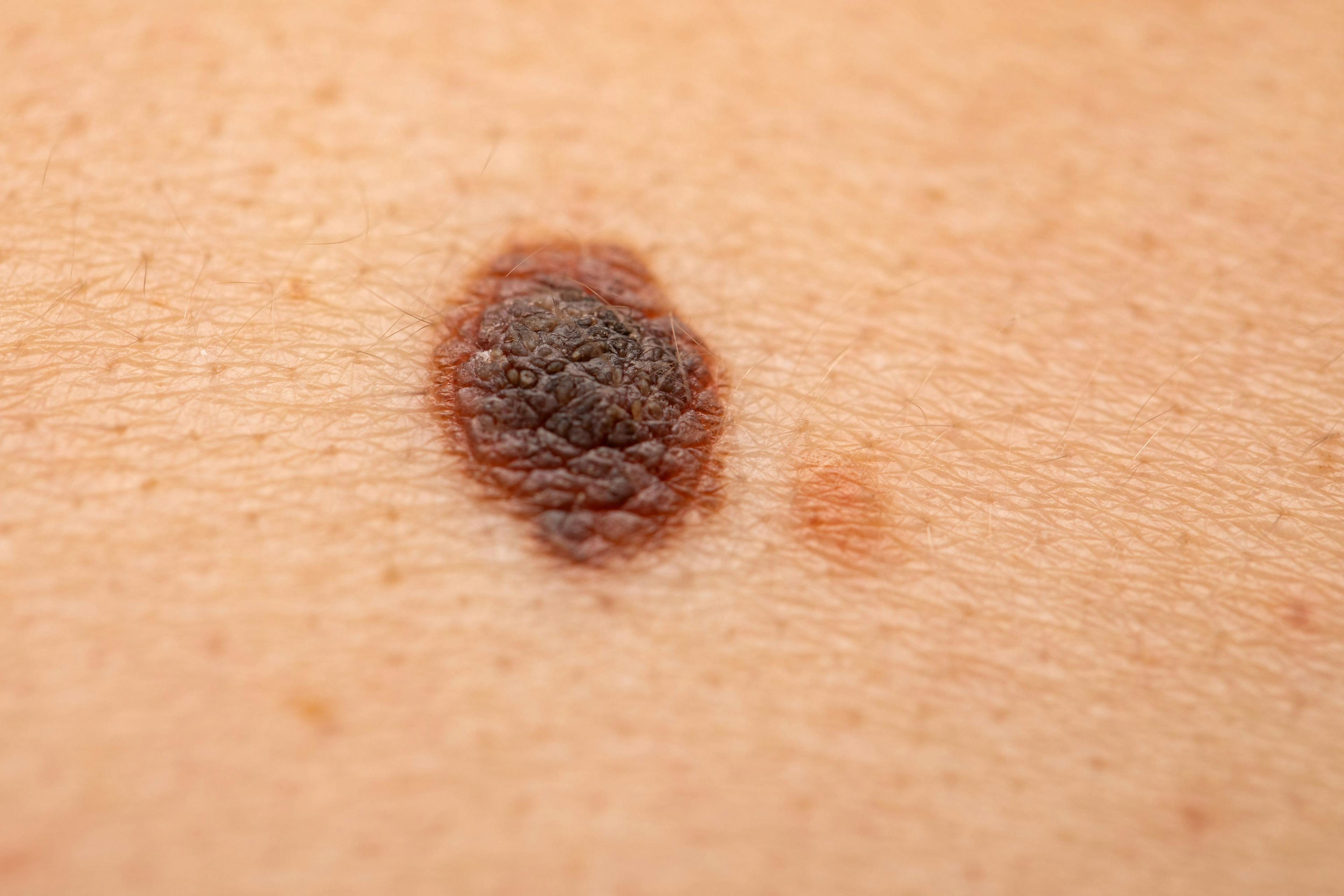 Melanoma on Skin | image credit: Ocskay Mark - stock.adobe.com