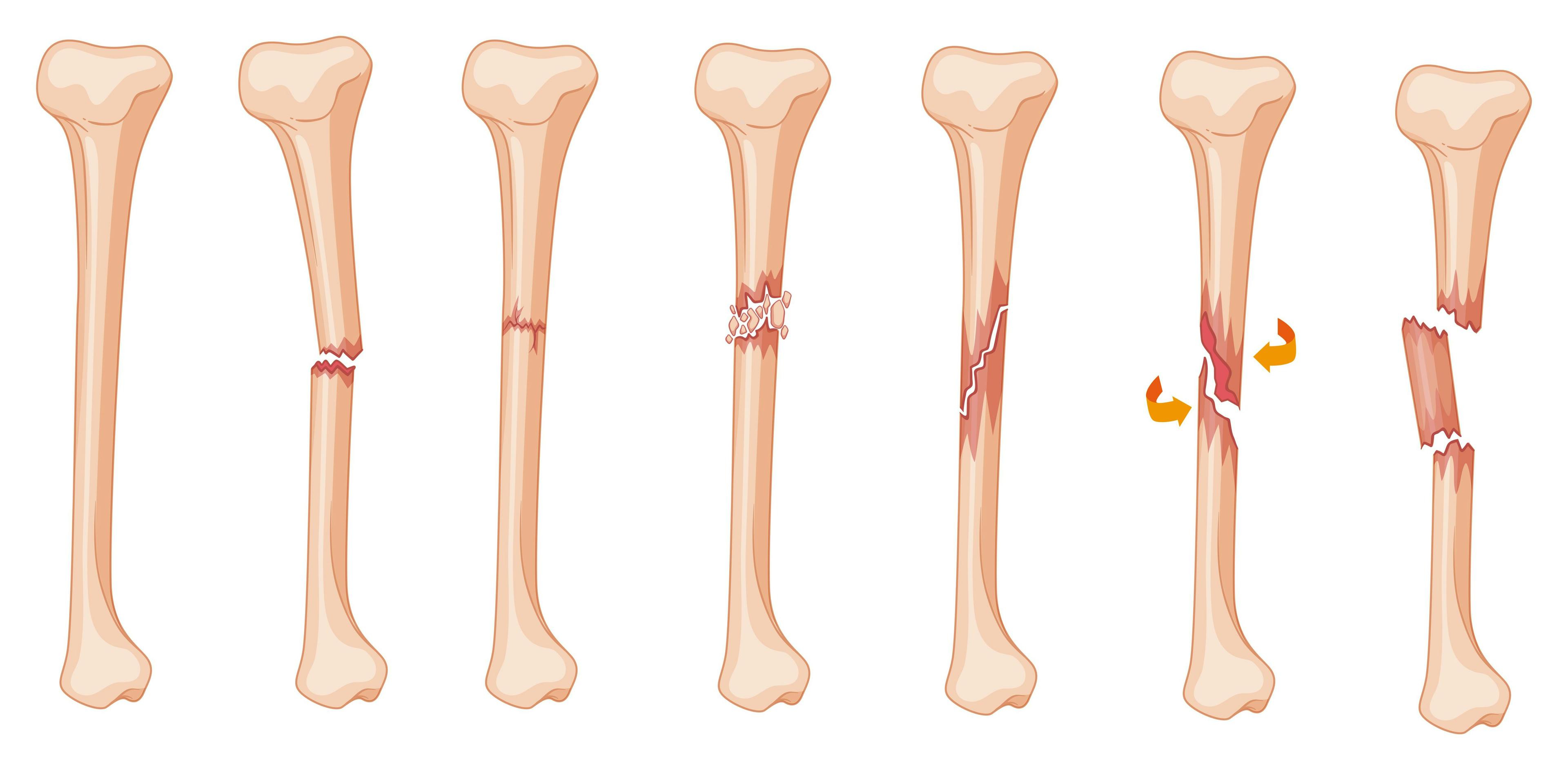 Leg Fracture Stages | image credit: GraphicsRF - stock.adobe.com