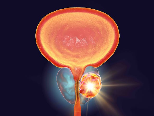 Prostate cancer illustration | Image credit: Dr_Microbe - stock.adobe.com