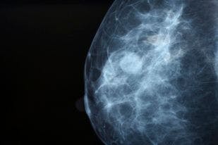 Using AI to Process Mammography Results in Place at Massachusetts General 