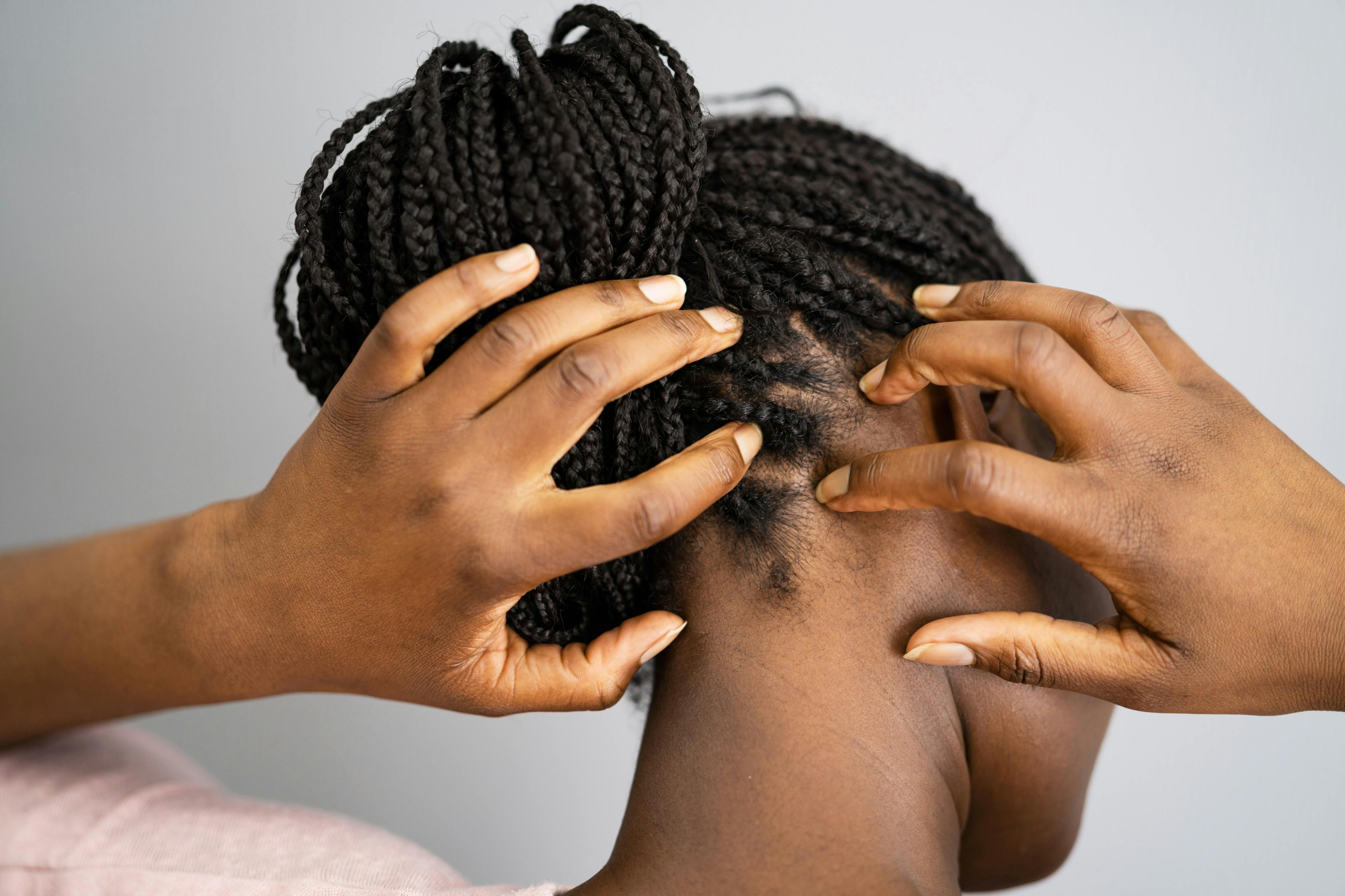 Itchy scalp with braids | Image Credit: Andrey Popov - stock.adobe.com