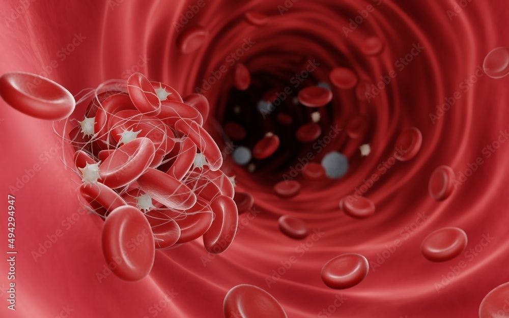 Blood clots (fibrin clots) are usually formed to stop the bleeding during injury, Blood clots can be dangerous when they obstruct blood flow and cause thrombosis | Image Credit: Artur - stock.adobe.com
