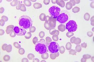 Higher Spleen Volume at HSCT Associated With Worse Outcomes in AML
