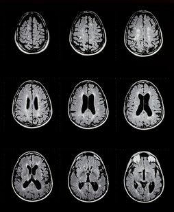 Higher Strength MRI Offers Greater Detection of Cortical Lesions in MS