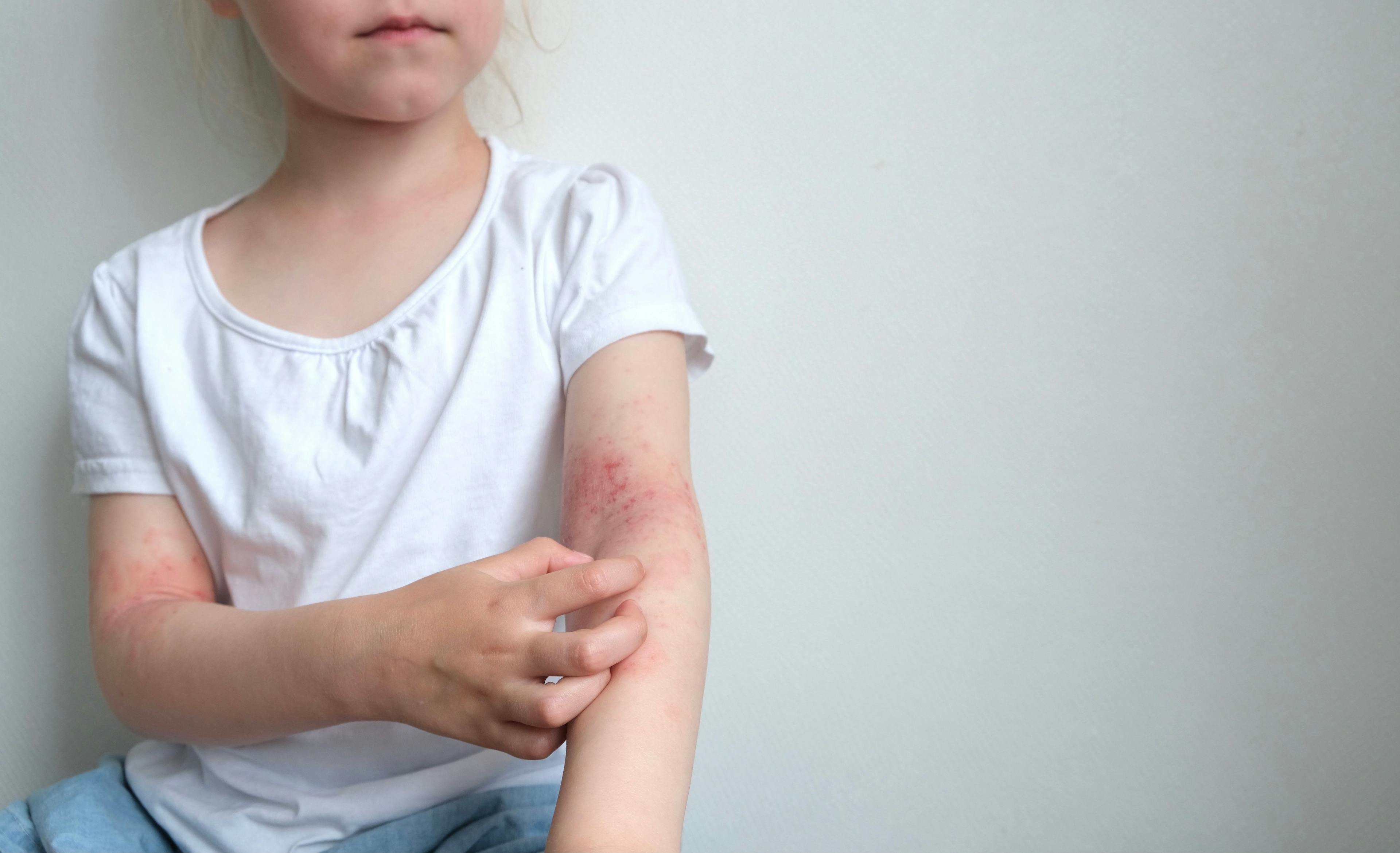 Child with atopic dermatitis (AD) | Image Credit: Марина Терехова - stock.adobe.com