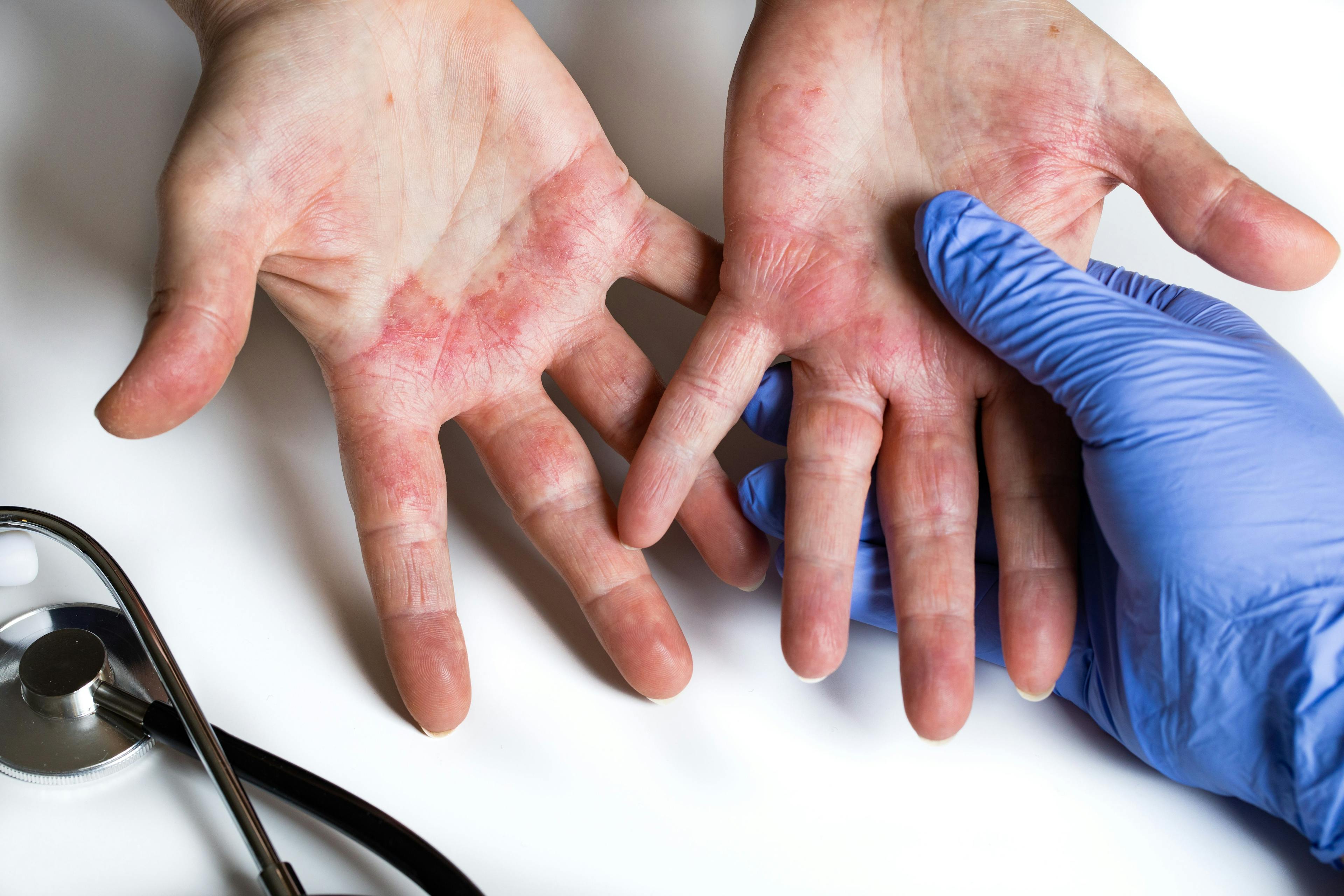 Atopic dermatitis. Red, itchy hands with blisters seen by a dermatologist | Image credit: Rochu_2008 - stock.adobe.com