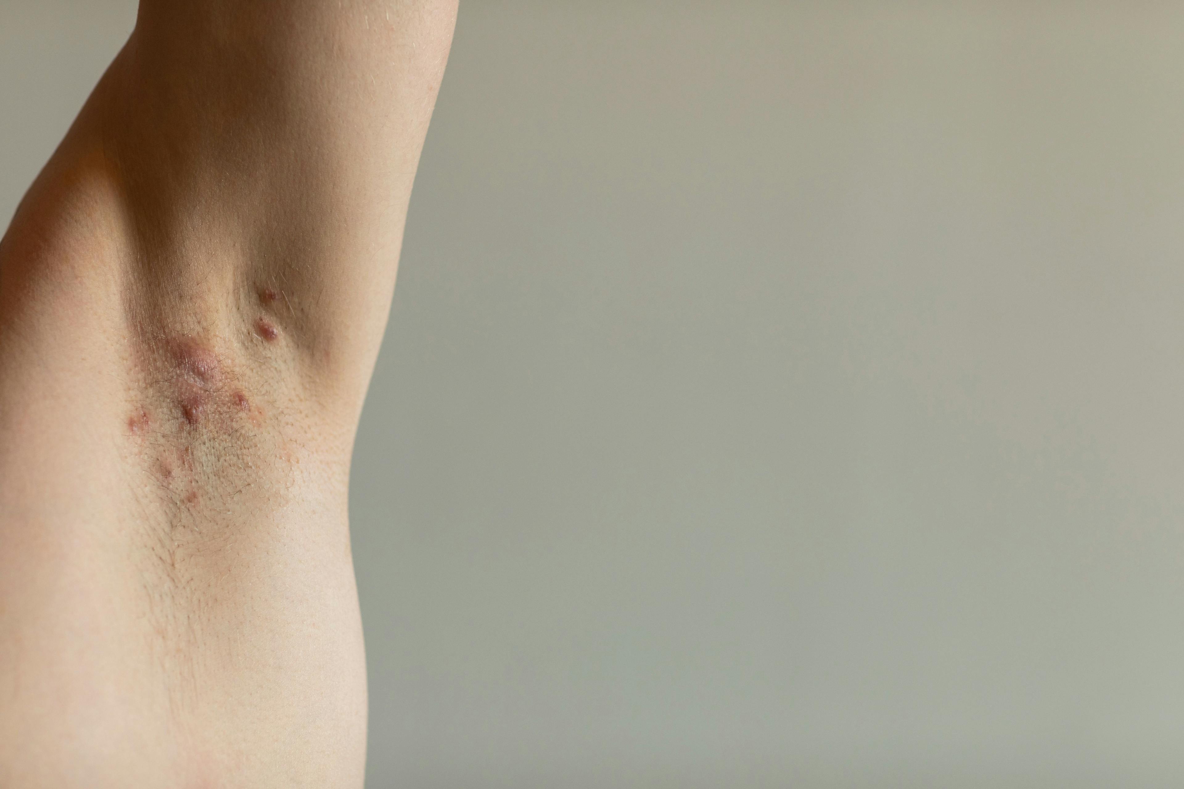 Woman with hidradenitis suppurativa under arm | Image credit: Lea - stock.adobe.com