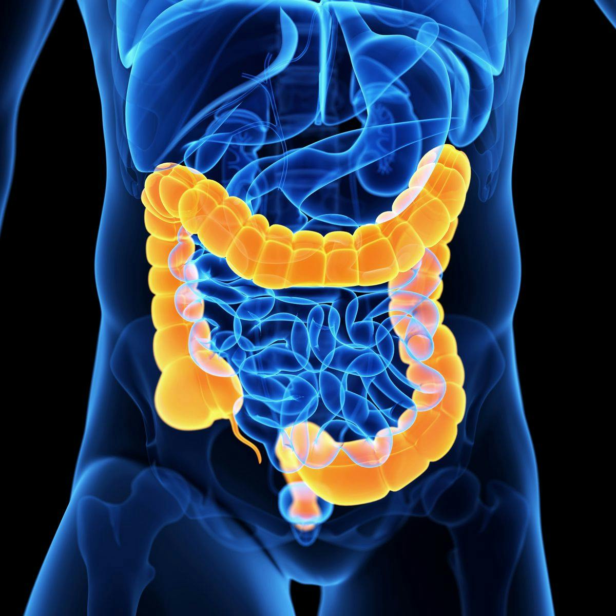 Artificial Intelligence May Help Differentiate Colon Carcinoma From Acute Diverticulitis