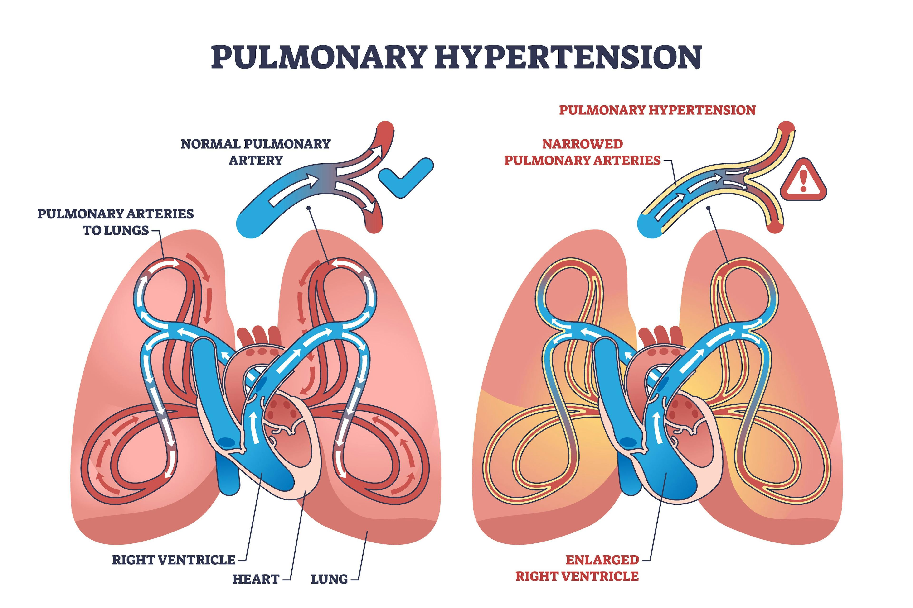Pulmonary hypertension with narrow arteries and blockage | Image credit: VectorMine - stock.adobe.com