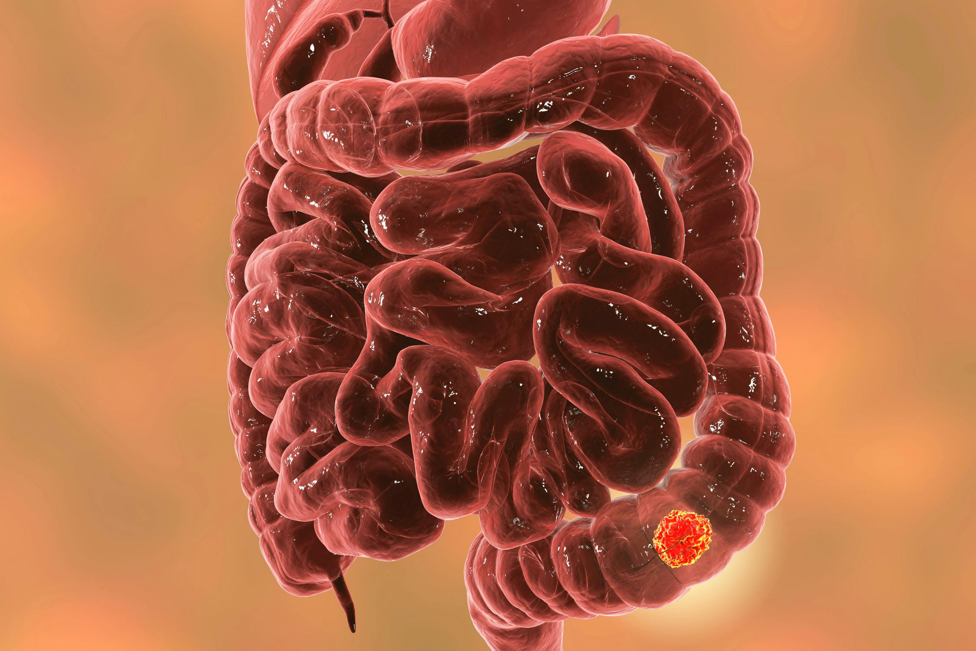 Colorectal cancer | Image credit: Dr_Microbe - stock.adobe.com