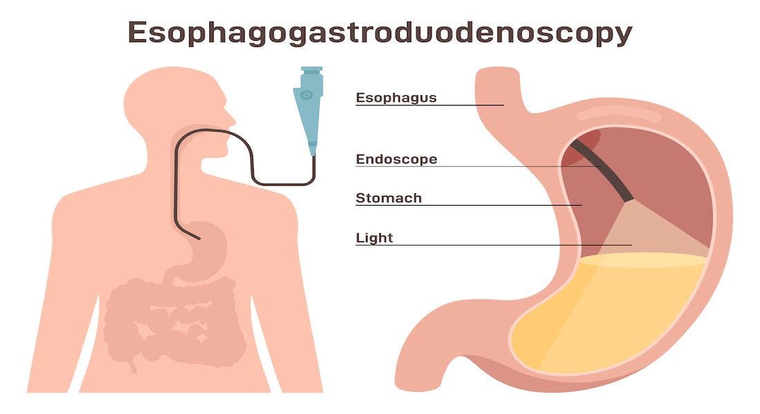 Esophagogastroduodenoscopy. Medical diagnostics of the esophageal, stomach: © inspiring.team - stock.adobe.com