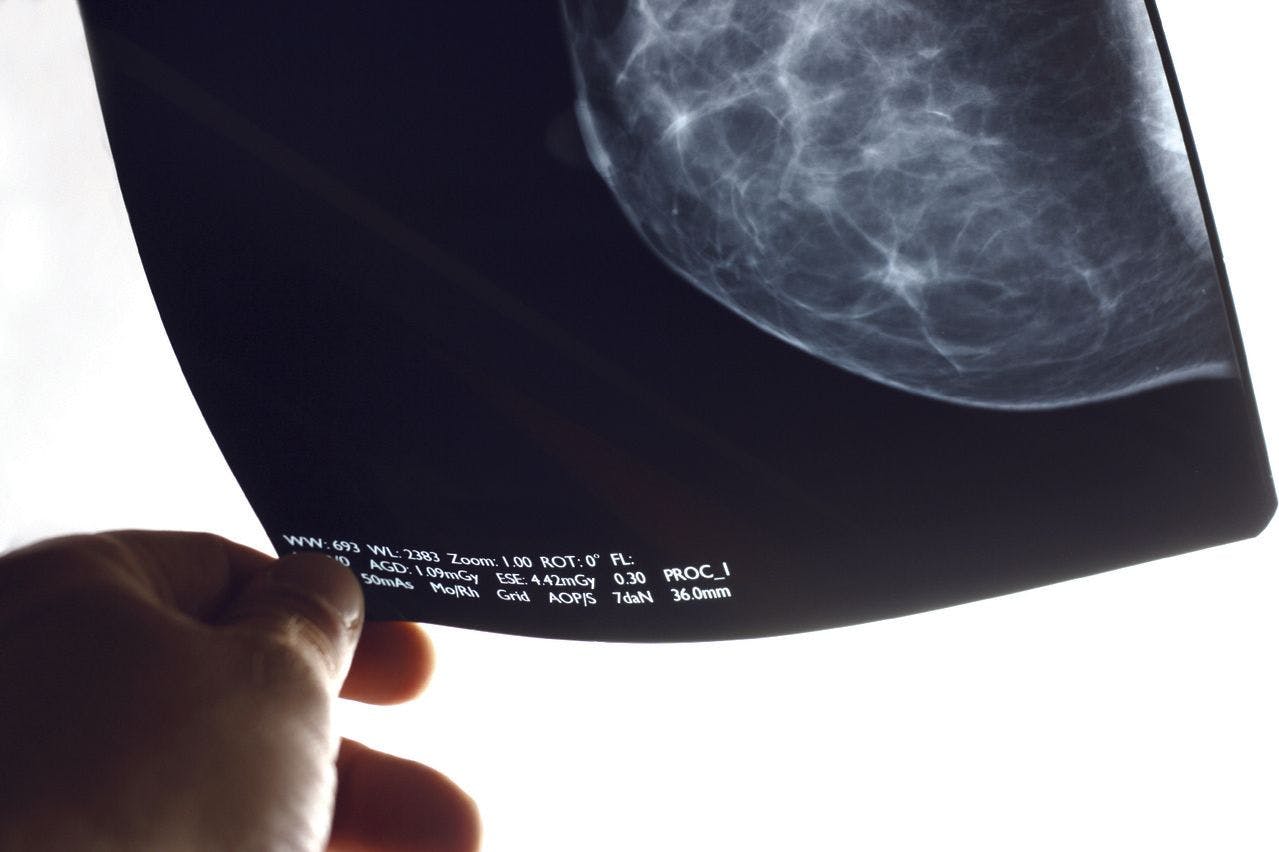 Mammography image