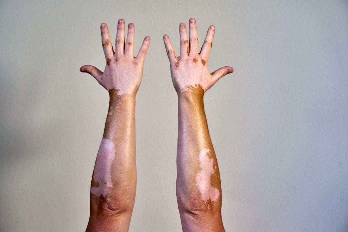Vitiligo skin disease on male hands | Image Credit: © Chris West/Wirestock Creators - stock.adobe.com.