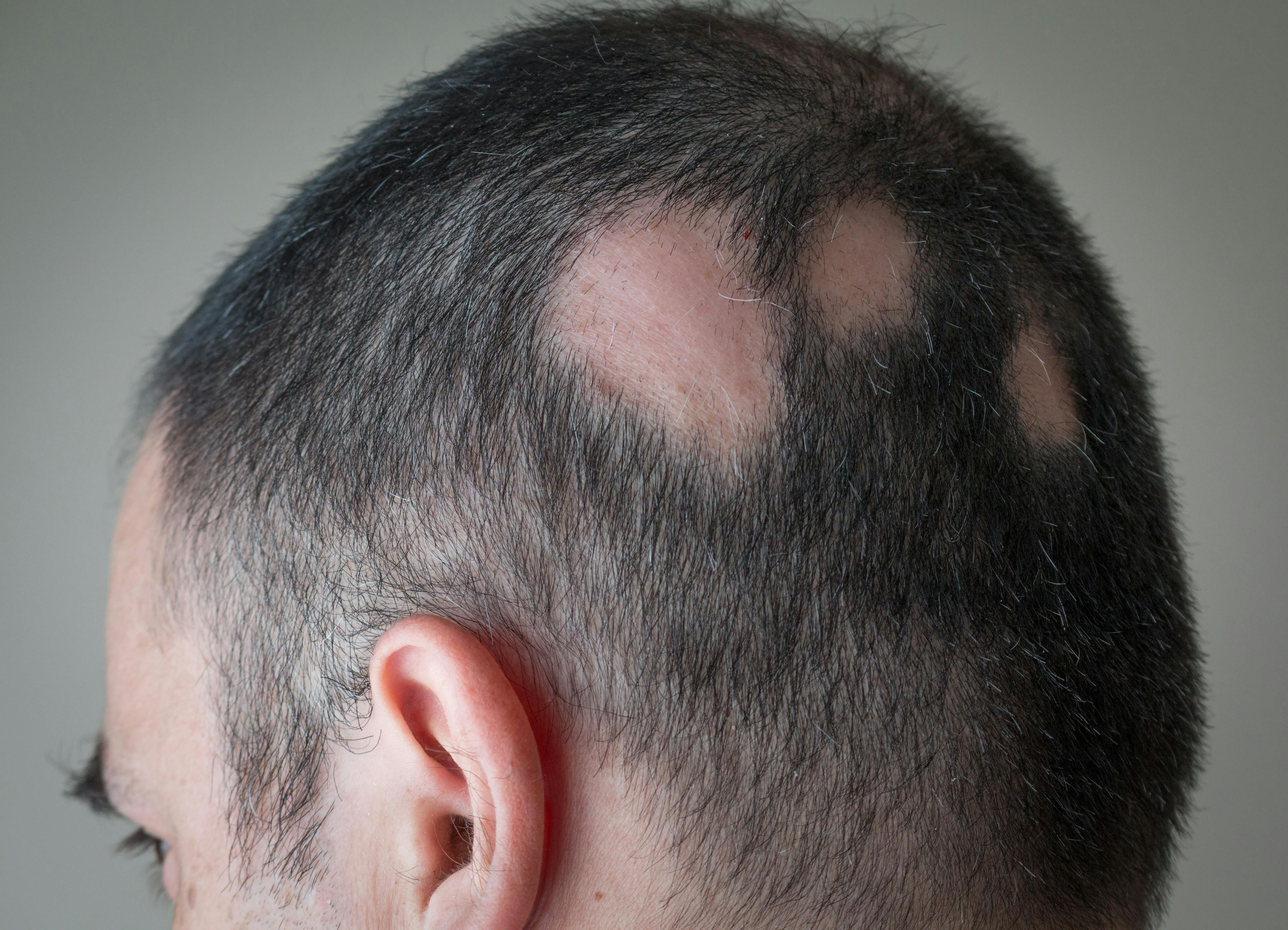 Man with bald patches | Image credit: alex papp - adobe.stock.com