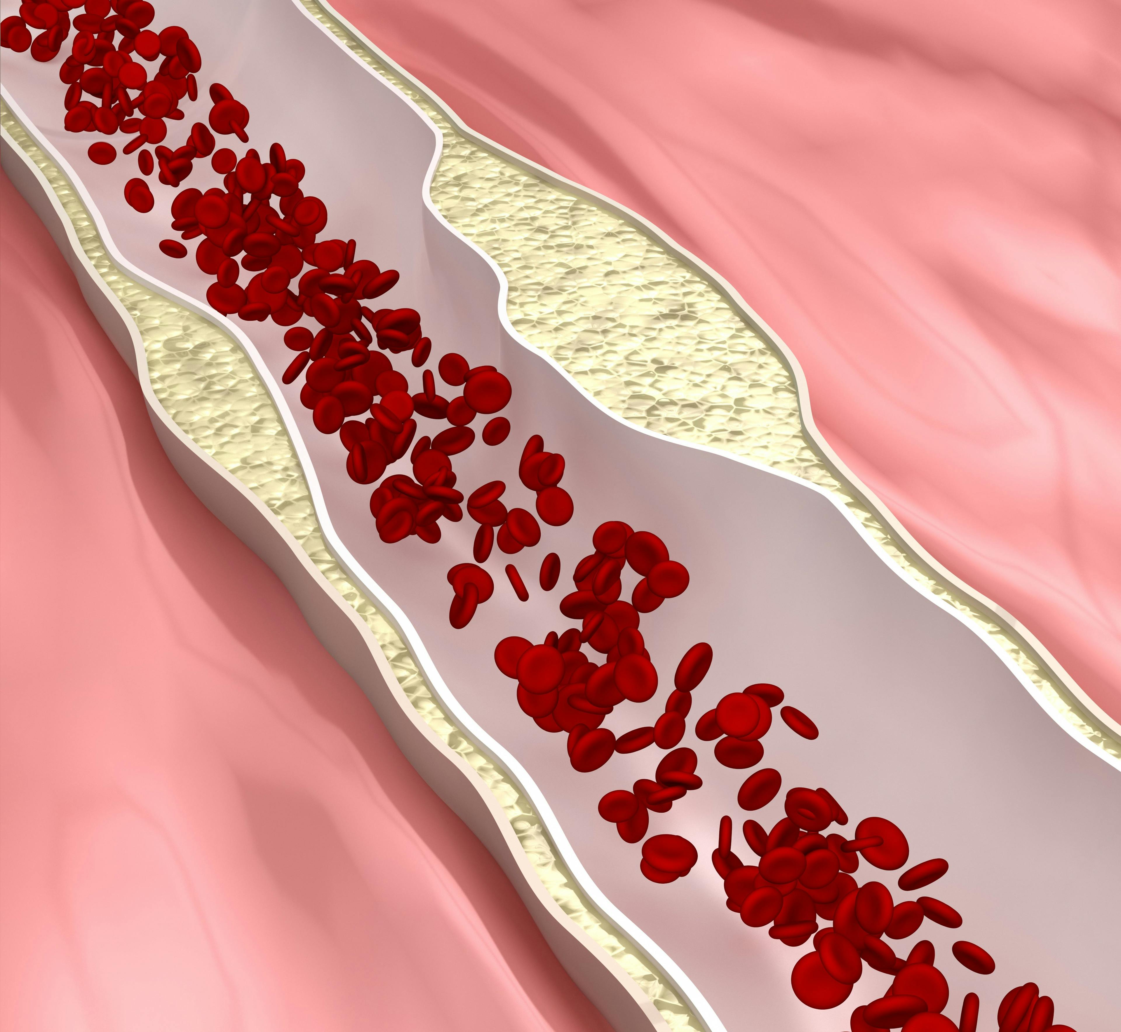 Patients With Fabry Likely Experience Accelerated Atherosclerosis, Study Finds