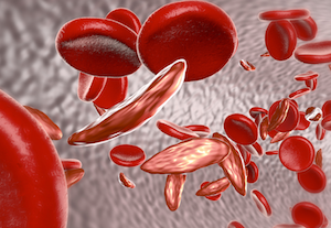 Study Documents Chronic Pain Associated With Sickle Cell Disease