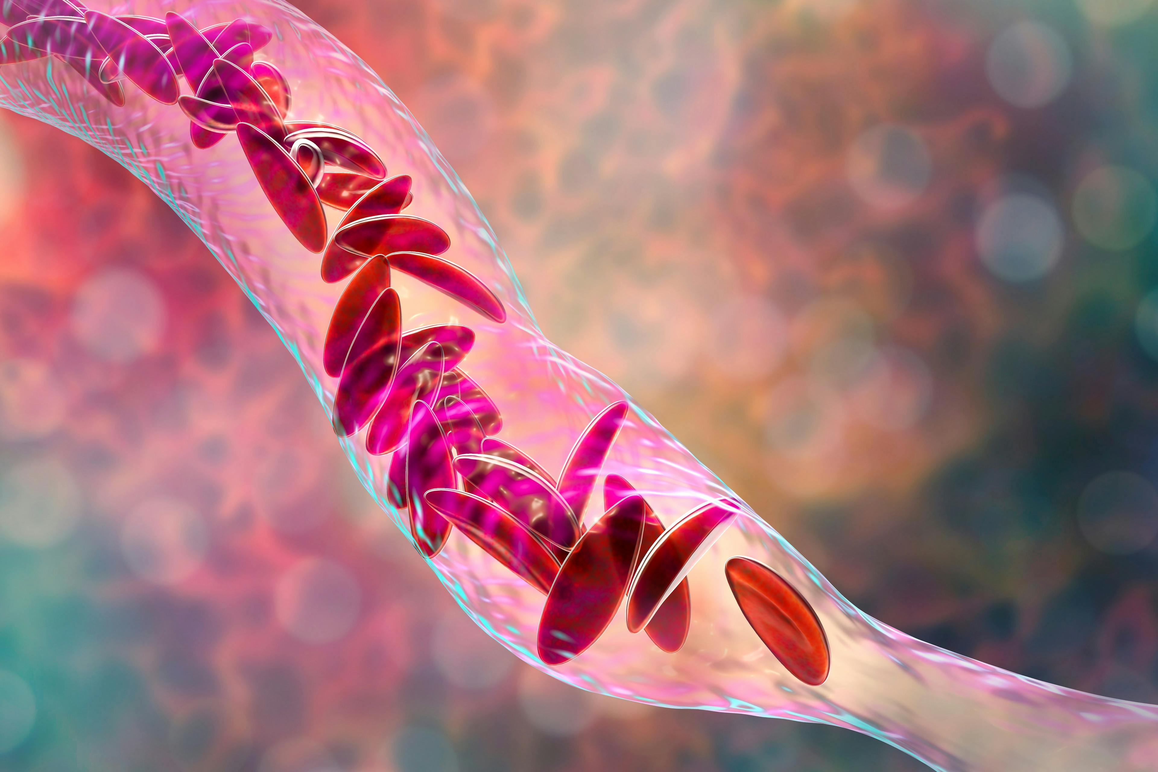 Sickle cell anemia, 3D illustration. | Image credit: Dr_Microbe - stock.adobe.com