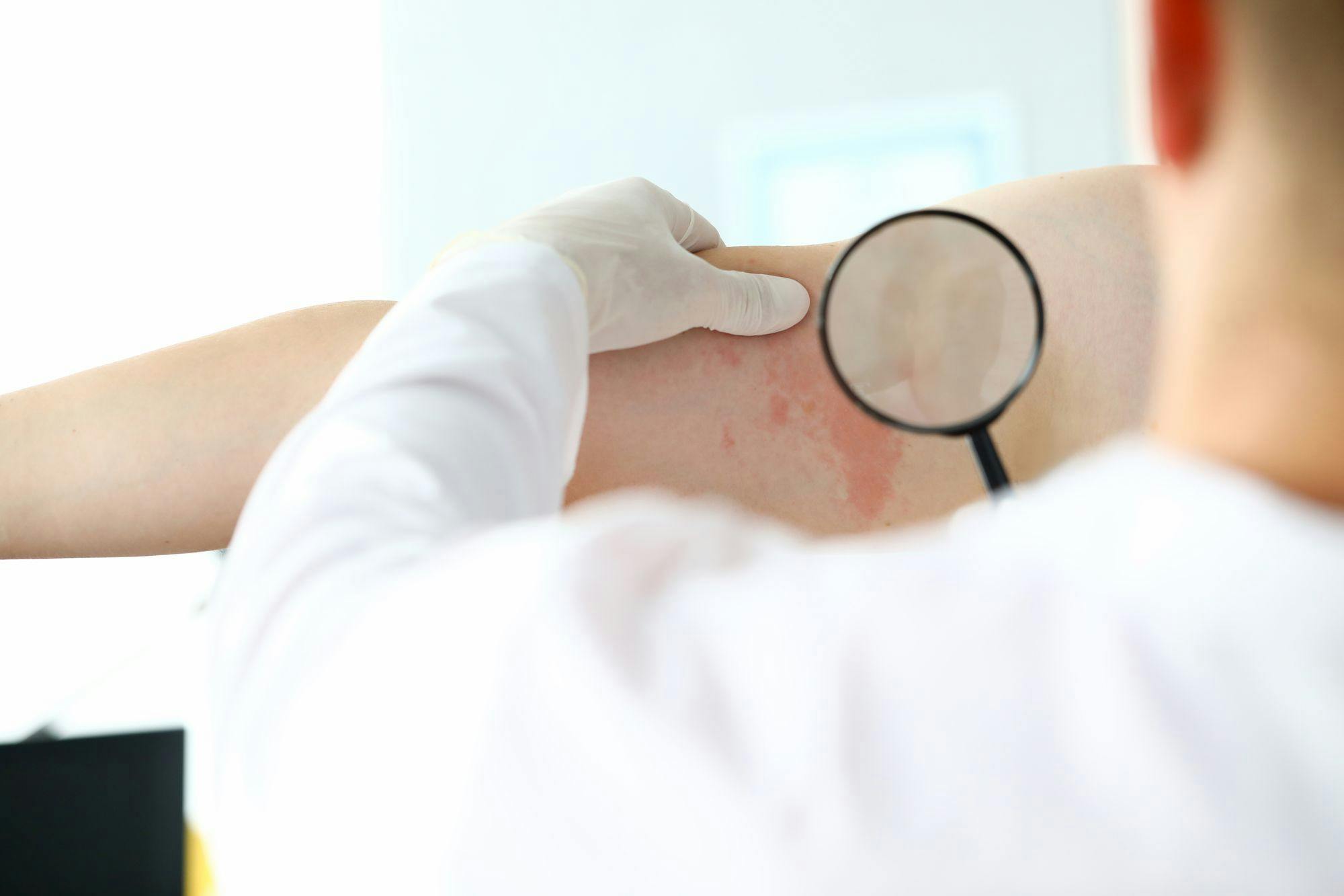 doctor looking at rash on patient's arm using magnifying glass