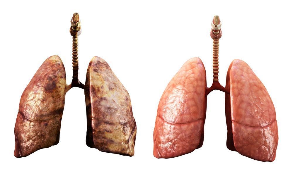 Image of healthy and diseased lungs