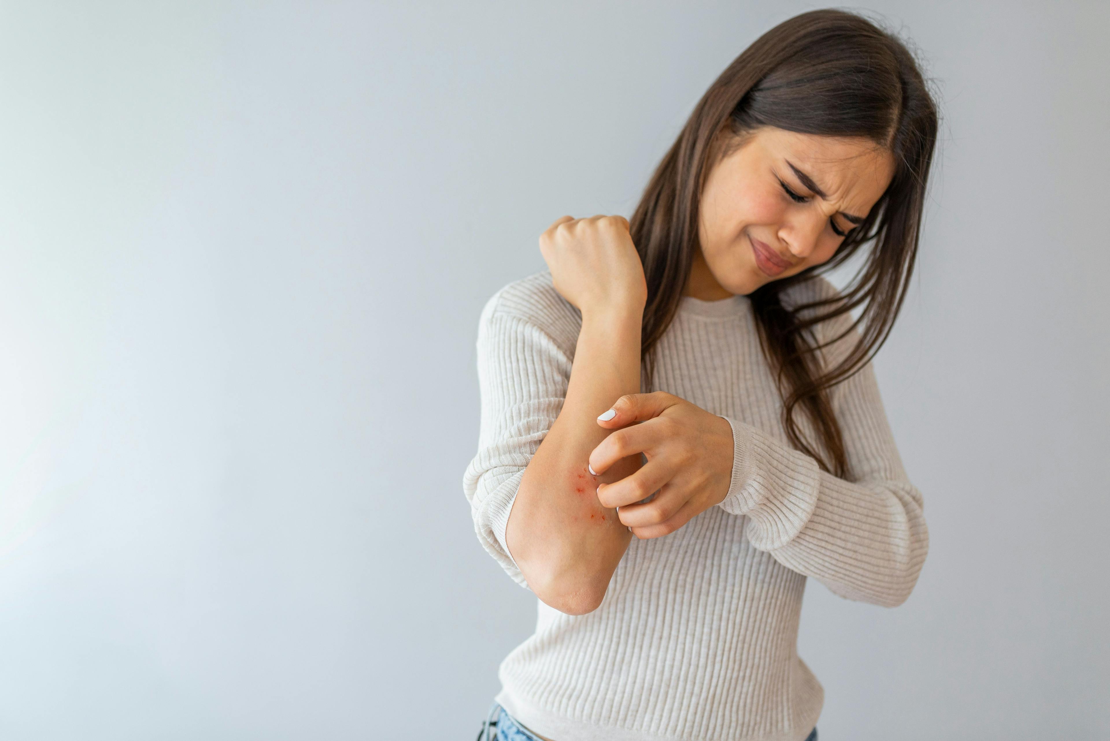 Allergy symptoms. Woman scratching her arm | Dragana Gordic - stock.adobe.com