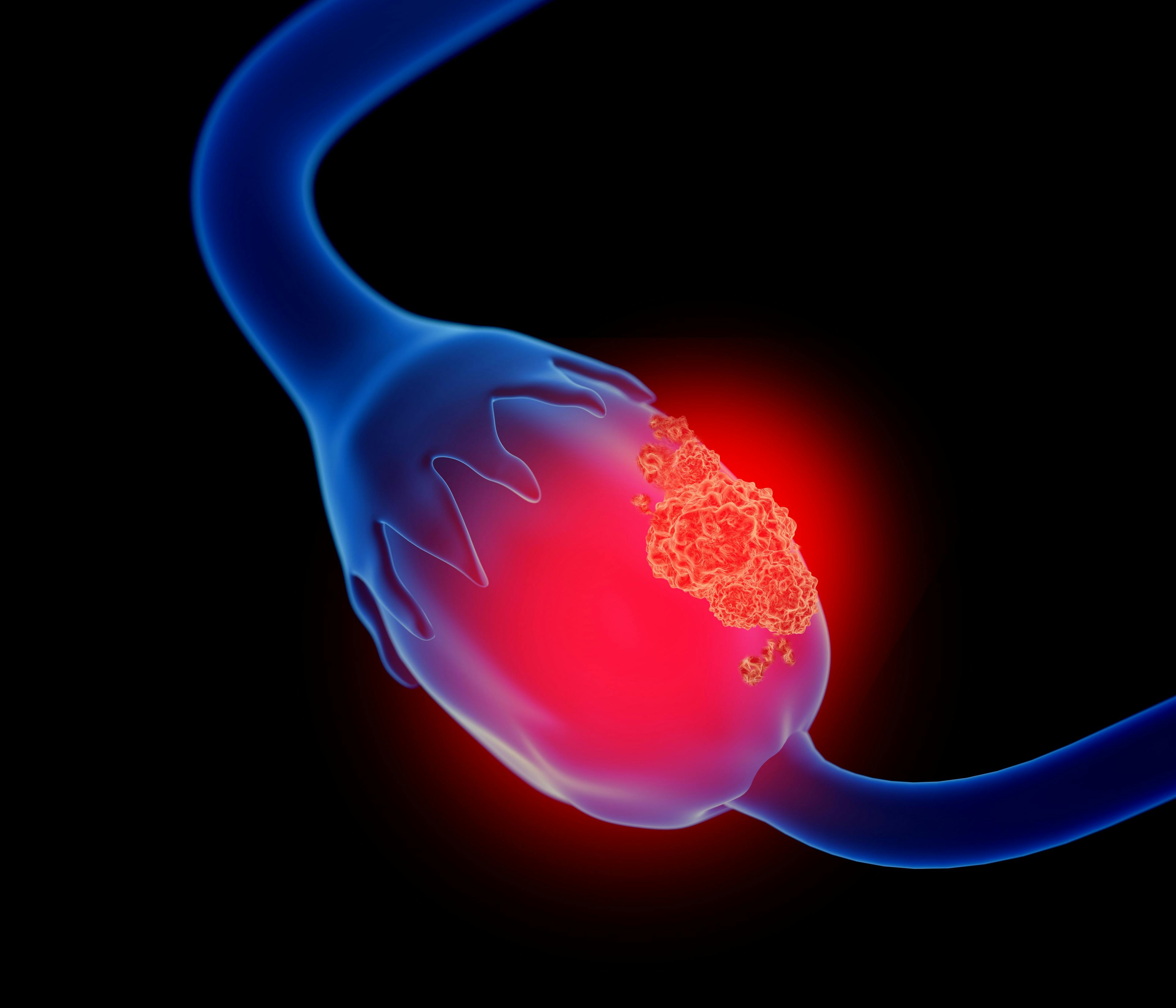 3D illustration of ovarian cancer | Image Credit: Lars Neumann - stock.adobe.com