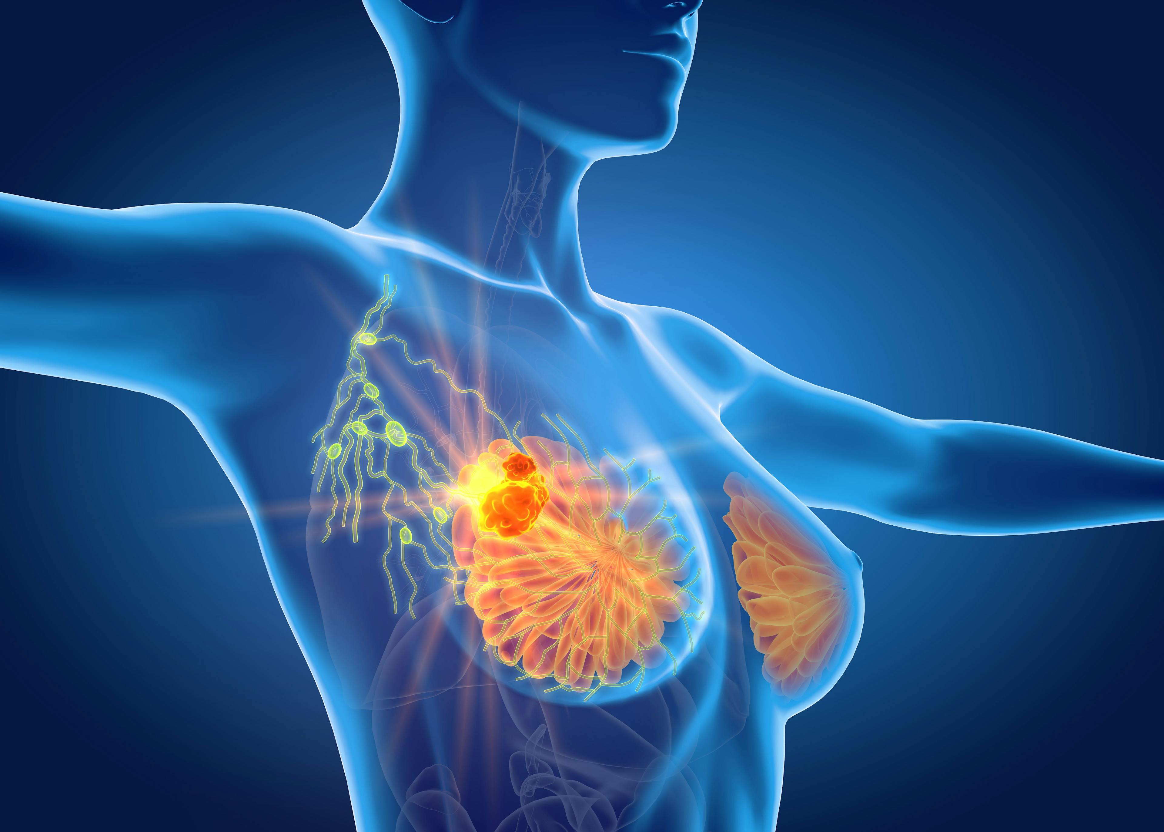 Breast cancer with lymphatics, medically 3D illustration | Image credit: Axel Kock - stock.adobe.com