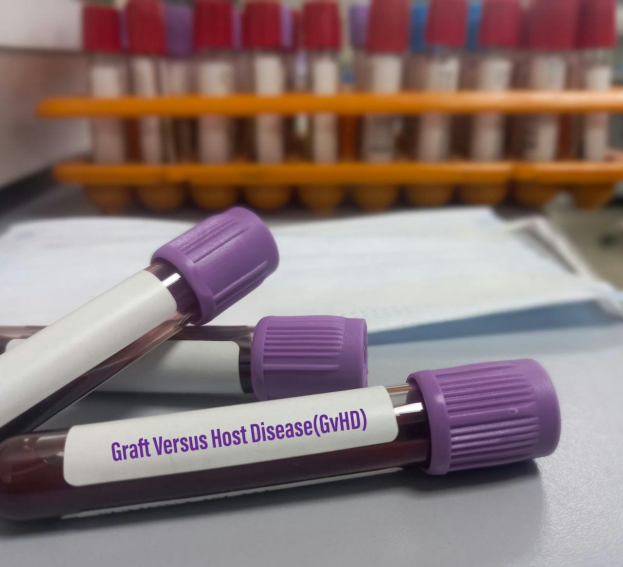Image of blood sample testing for GHVD: MdBabul - stock.adobe.com