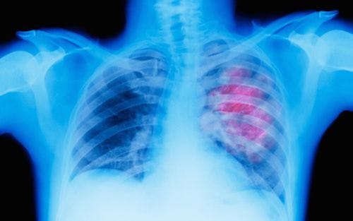 Genomic Test for Suspicious Lung Nodules Available Through J&J Initiative