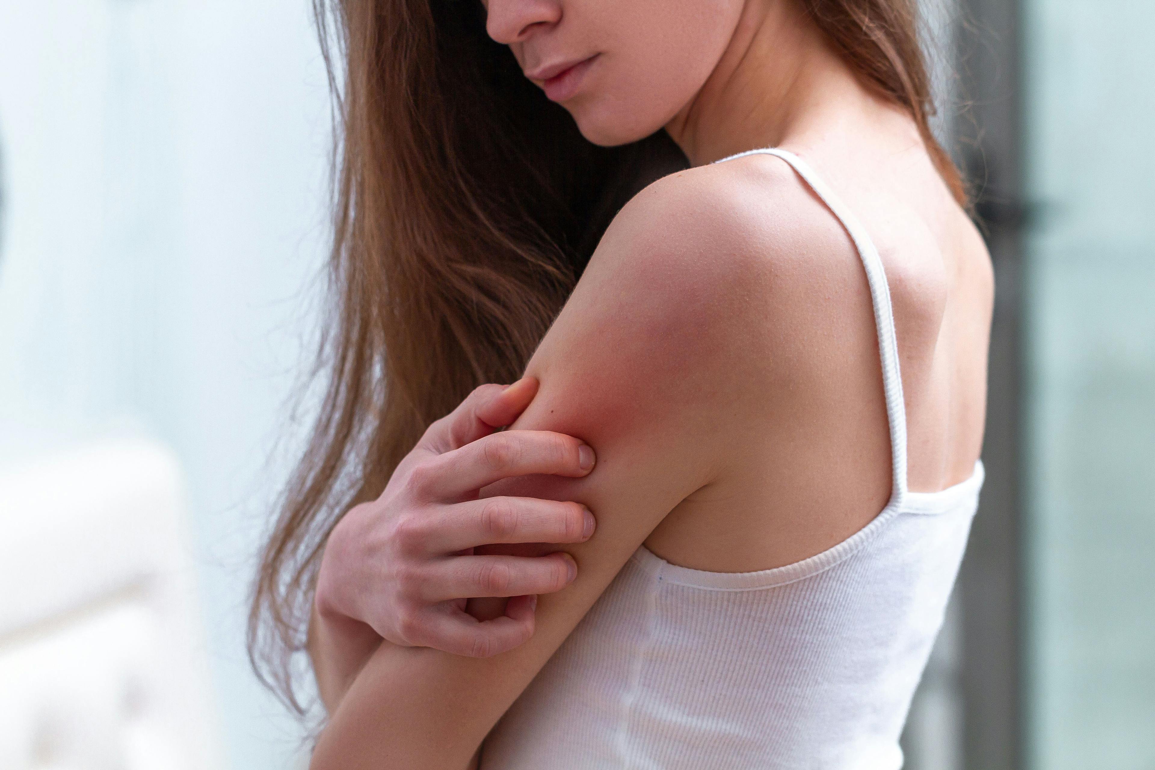 Young woman suffering from itching on her skin and scratching an itchy place | Goffkein - stock.adobe.com