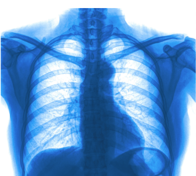 Patients With Down Syndrome Have Higher Risk of Pulmonary Hemosiderosis