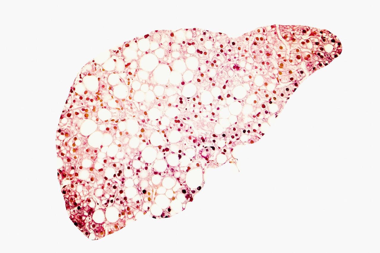 Image of a fatty liver