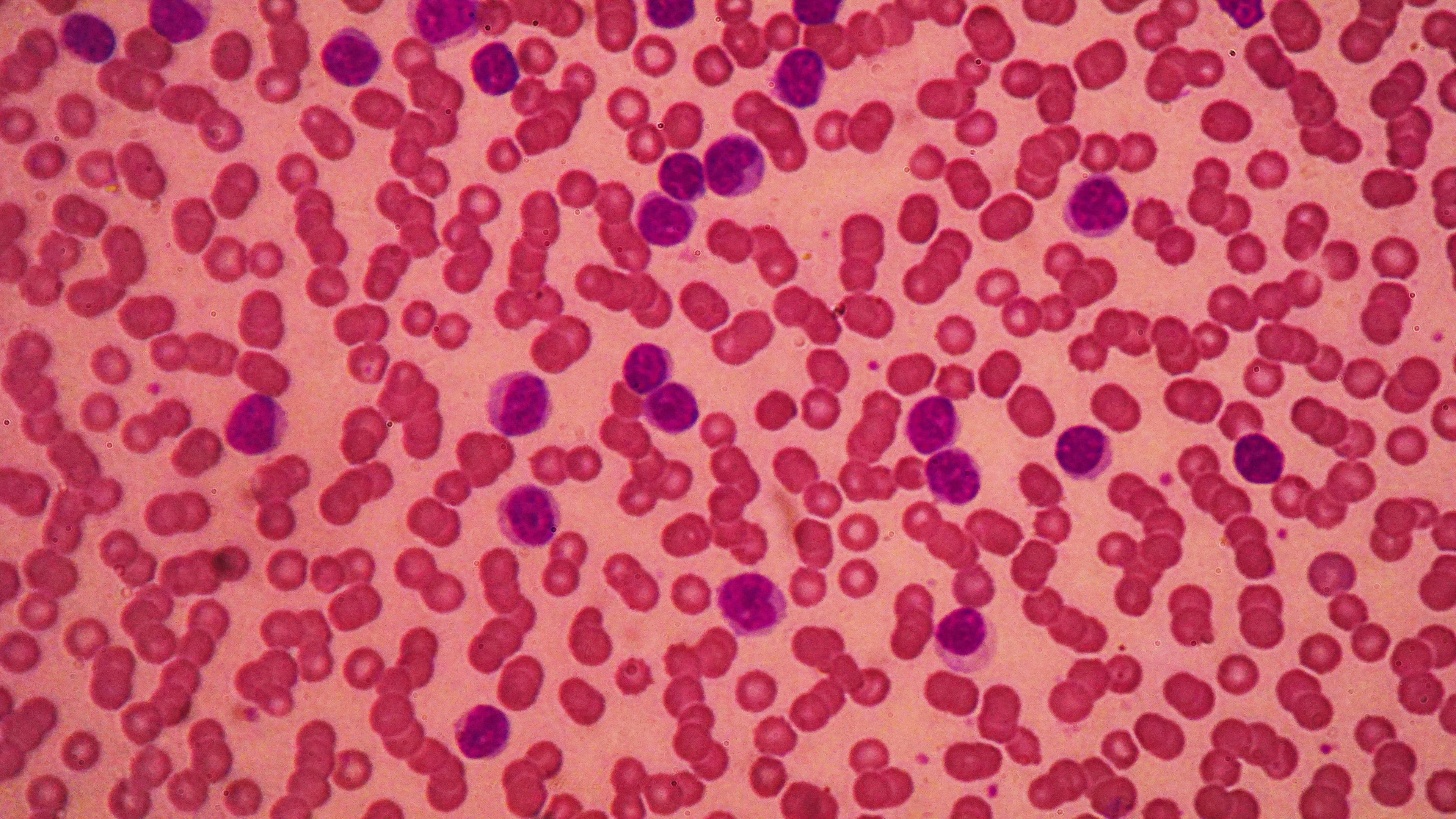 Image of chronic lymphocytic leukemia