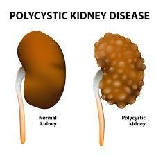 kidney with PKD