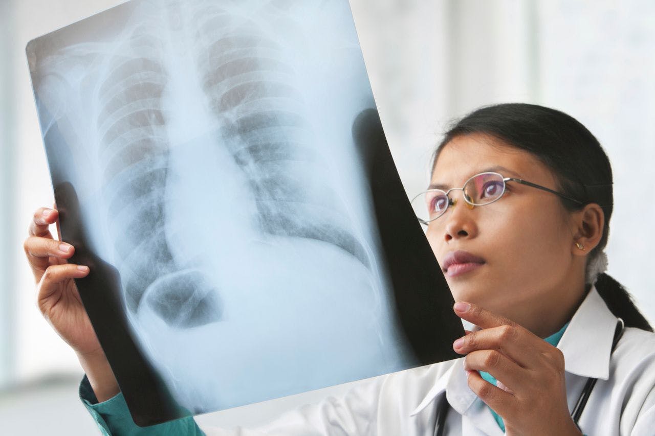 5 Things About Lung Cancer Screening Guidelines and Programs