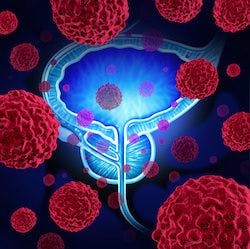 Study Finds PSMA-PET May Hold Prognostic Utility in Prostate Cancer