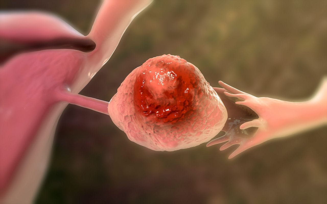 Ovarian cancer, 3D illustration: © Dr_Microbe - stock.adobe.com