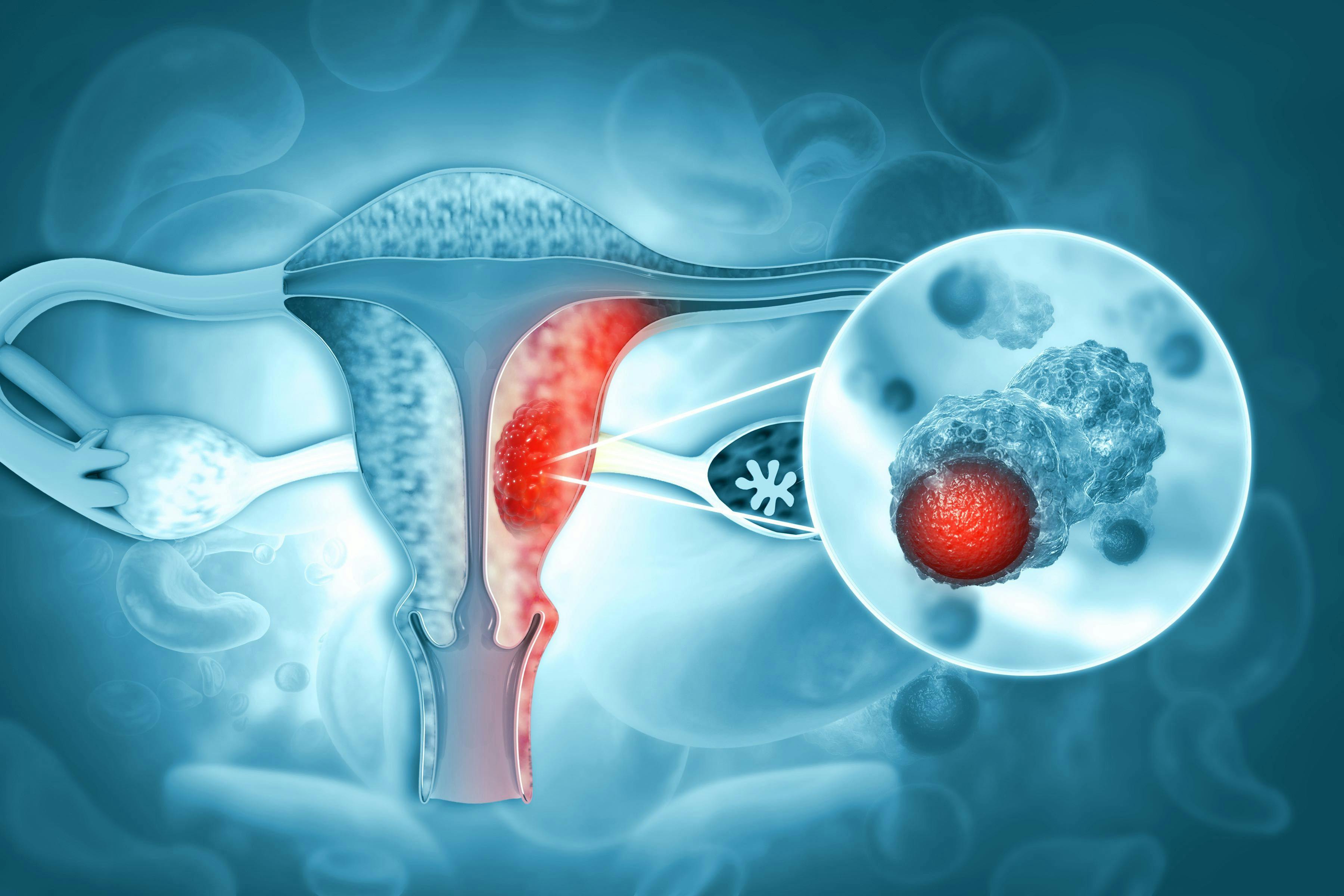 Endometrial tumor | Image credit: Crystal light - stock.adobe.com