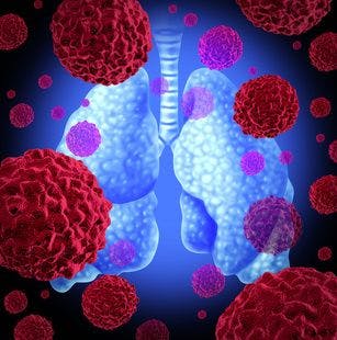 Spreading Awareness of the Risk of Lung Cancer in Patients with COPD