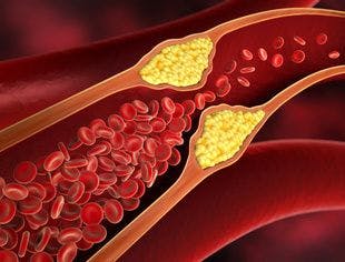 Asymptomatic Adults Do Not Need Peripheral Artery Disease Screening, USPSTF Says