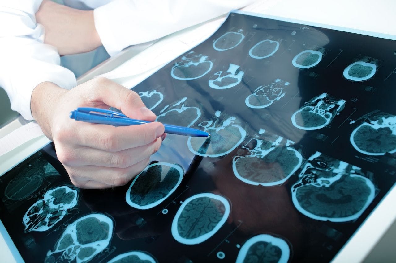 Brain Atrophy as a Potential Biomarker of Cognitive Impairment in Parkinson Disease